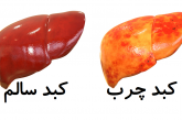 راههای درمان کبد چرب