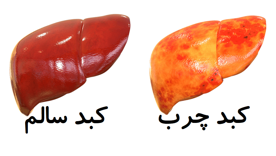 راههای درمان کبد چرب